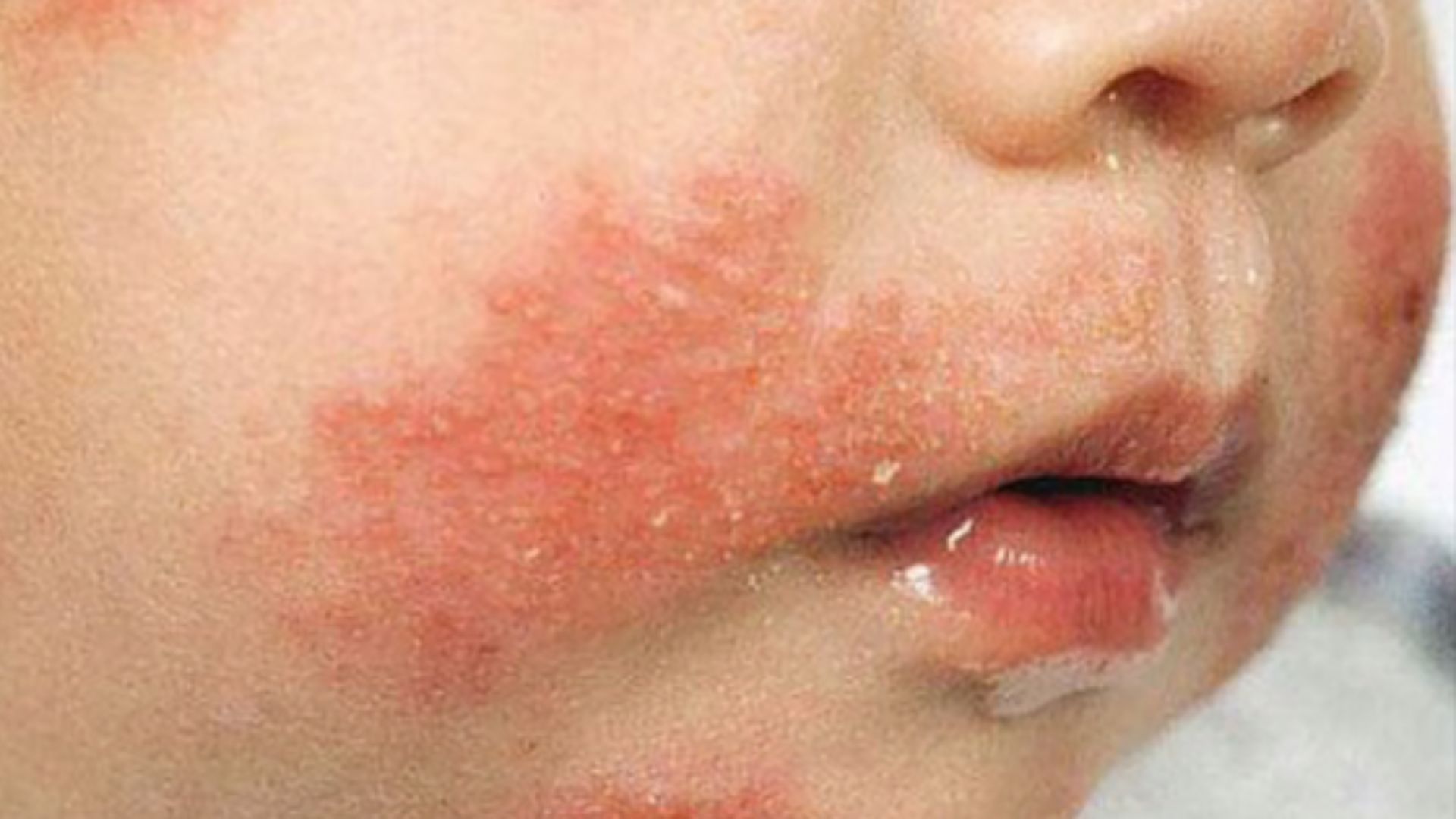 Triệu chứng dị ứng đạm sữa bò