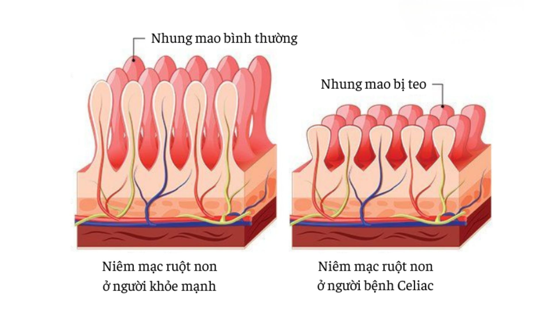 So sánh niêm mạc ruột non của người khoẻ mạnh và người bệnh Celiac