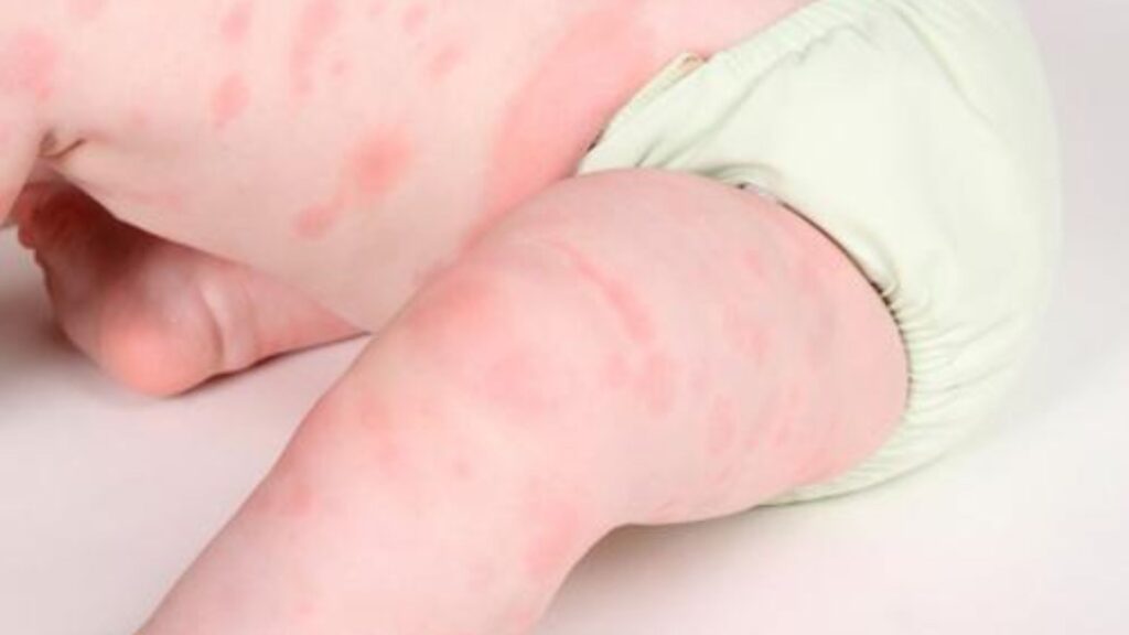Triệu chứng dị ứng gluten ở trẻ