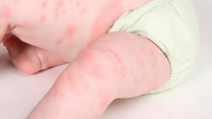 Triệu chứng dị ứng gluten ở trẻ