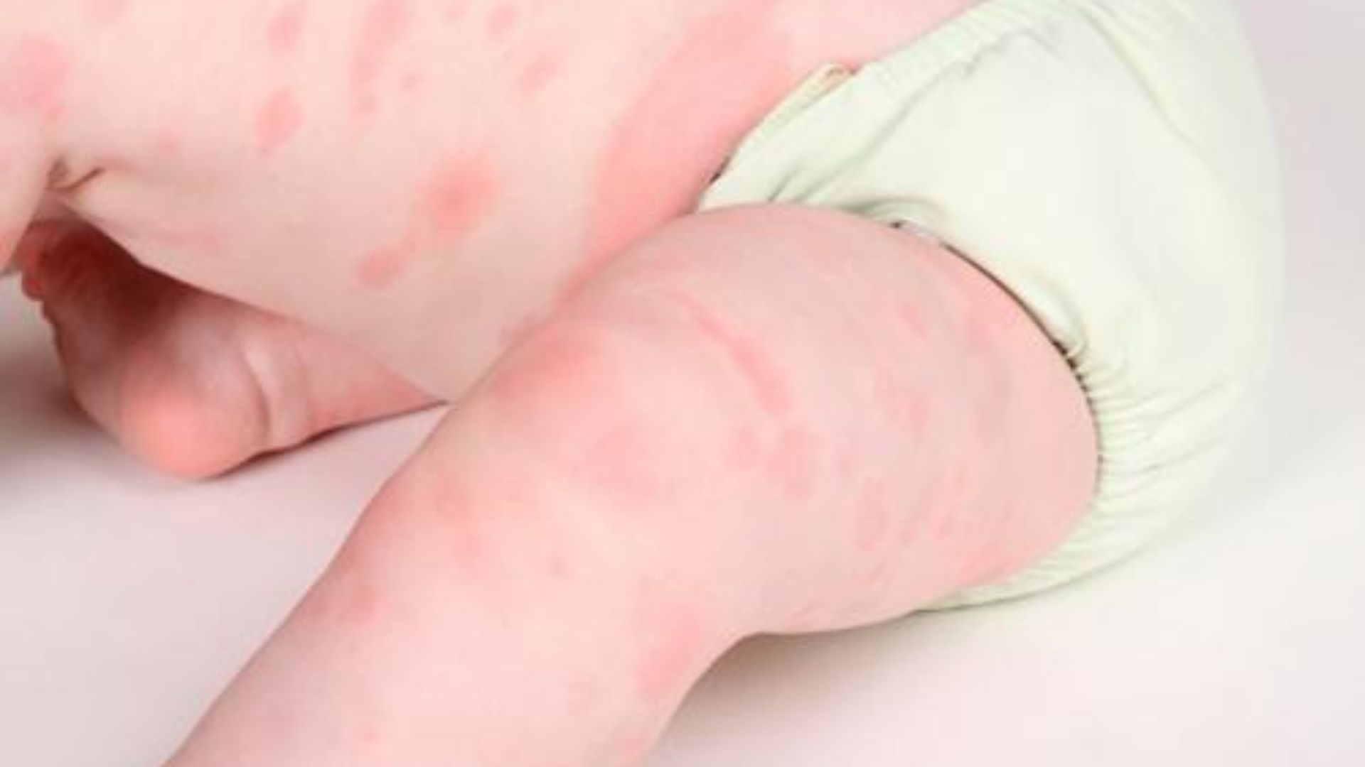 Triệu chứng dị ứng gluten ở trẻ